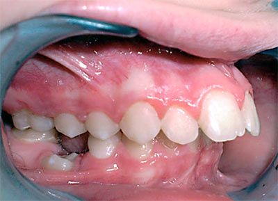 Salud oro-dental en niños y adolescentes con síndrome de Down