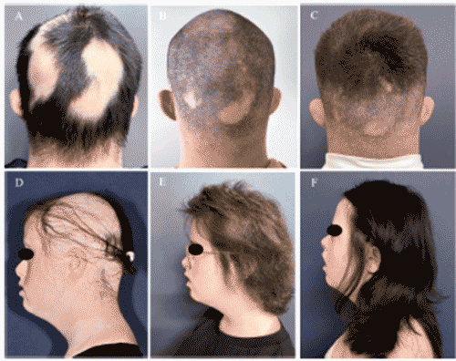 Baricitinib resolvió la alopecia areata y mejoró el vitíligo en personas con síndrome de Down.