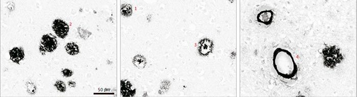 Lecunemab en la enfermedad de Alzheimer y en el síndrome de Down