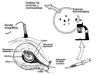 Modo de tomar una muestra de vellosidad coriónica