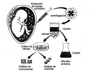Amniocentesis: modo de extraer el líquido amniótico
