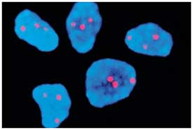 Cromosoma 21