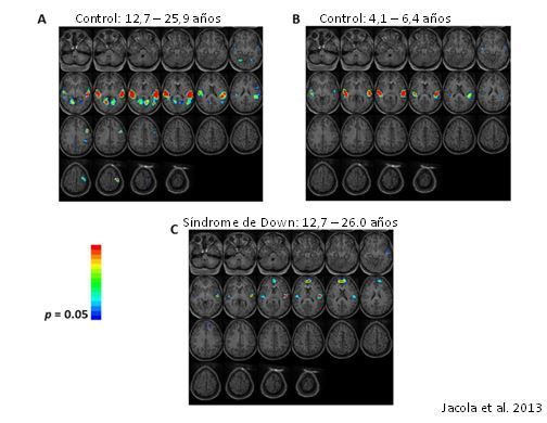  resonancia magnética en cerebros: