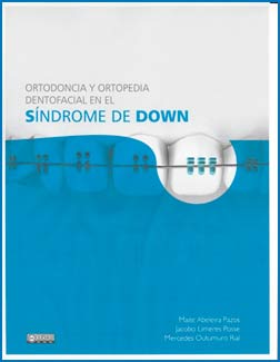 Ortodoncia y ortopedia dentofacial en el síndrome de Down