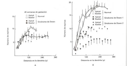 Síndrome de Down